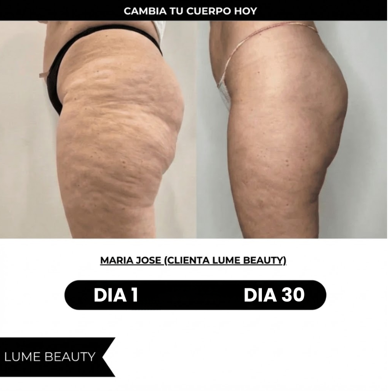 Aceite Anticelulitis - Adiós Flacidez y Arrugas