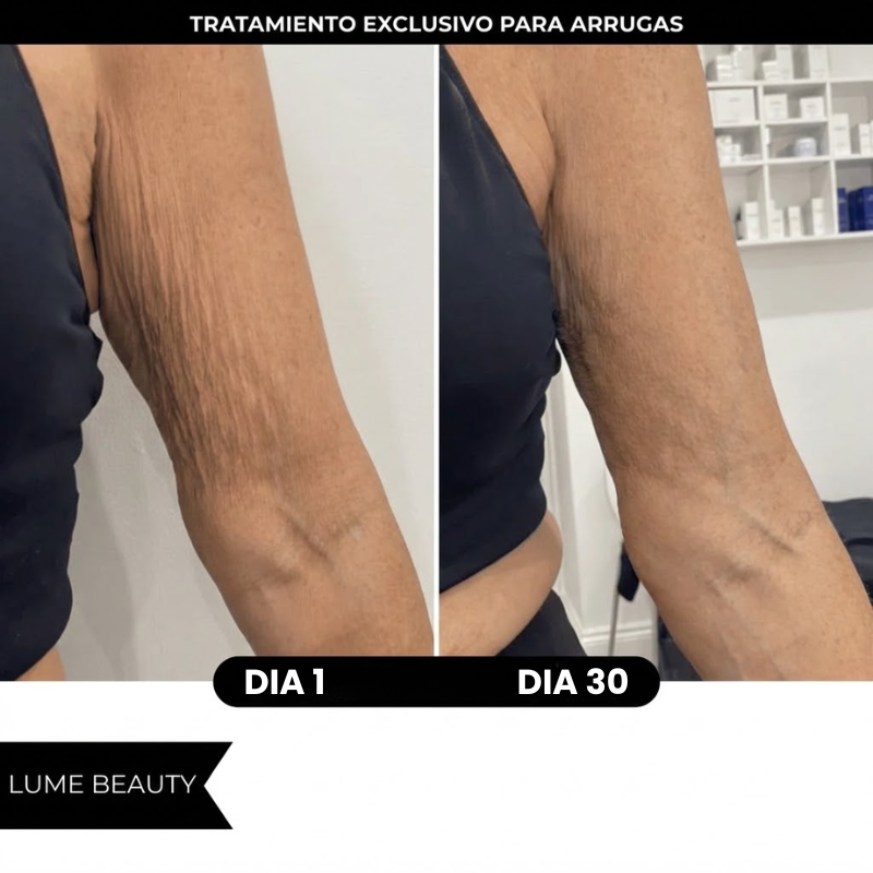 Aceite Anticelulitis - Adiós Flacidez y Arrugas